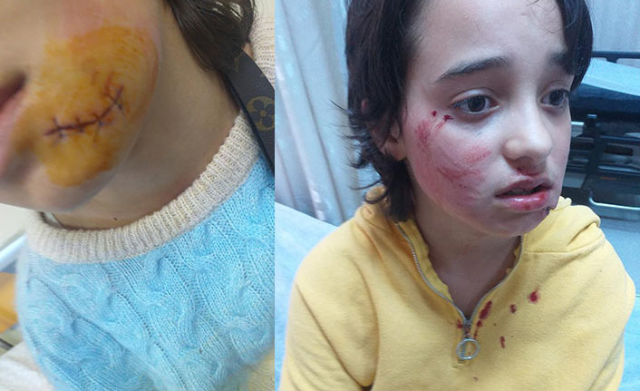 Rize'de sokak köpeği saldırdı! Çocuk yüzünden yaralandı
