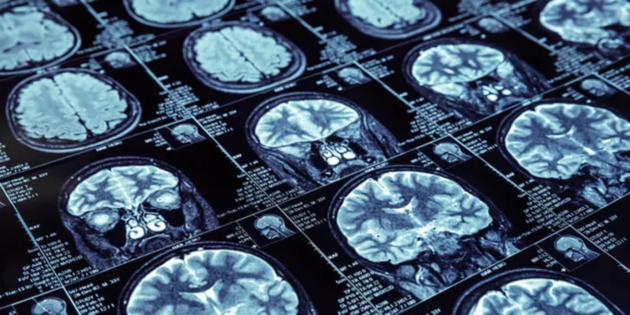 Yapay zeka Alzheimer'ı erken evrede tespit edecek