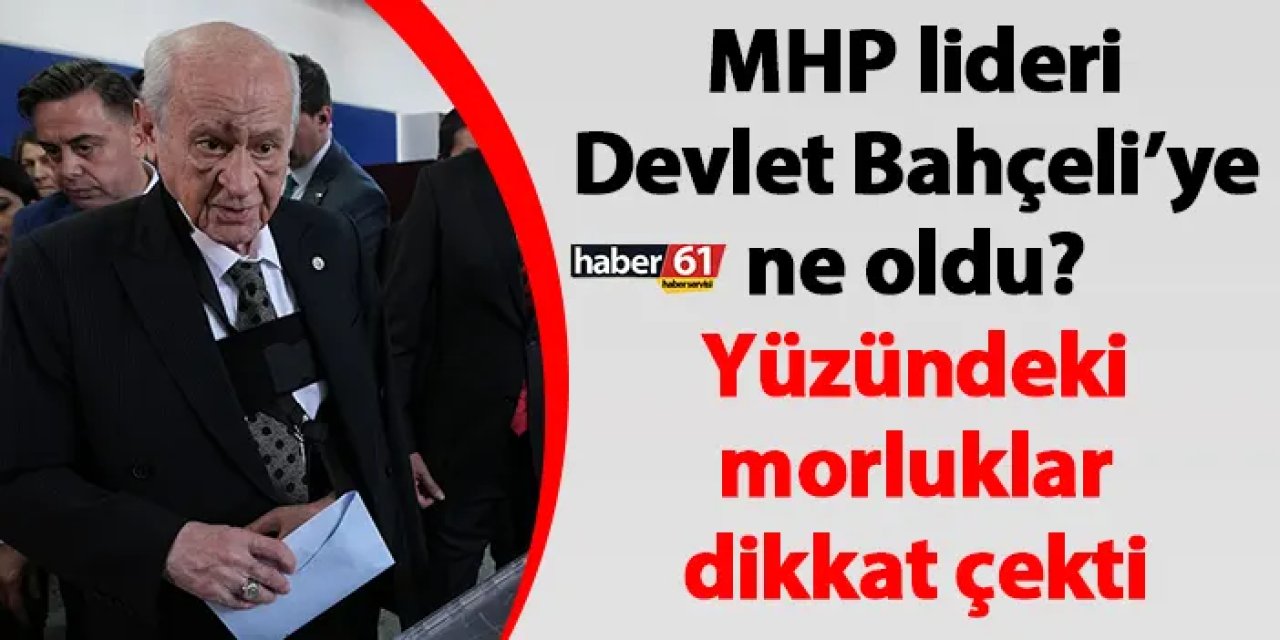 MHP lideri Devlet Bahçeli’ye ne oldu? Yüzündeki morluklar dikkat çekti