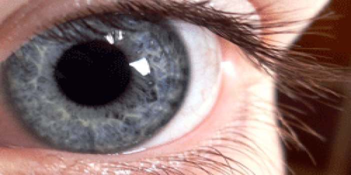 Lens çocuklarda körlüğe neden olabiliyor