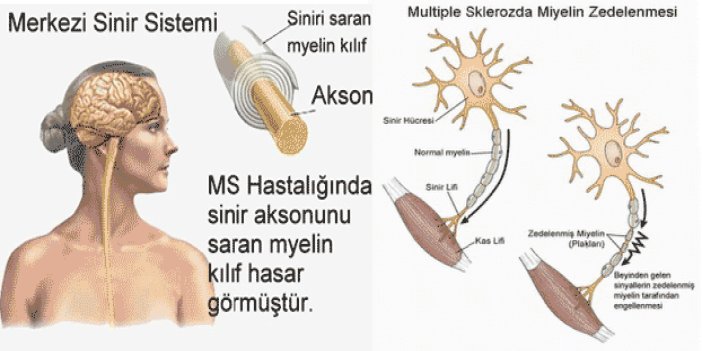 Trabzon'da MS Hasta yakınları bilgilendirilecek