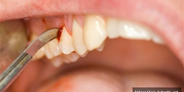 Diş eti problemleri ciddi hastalıkları tetikleyebilir!