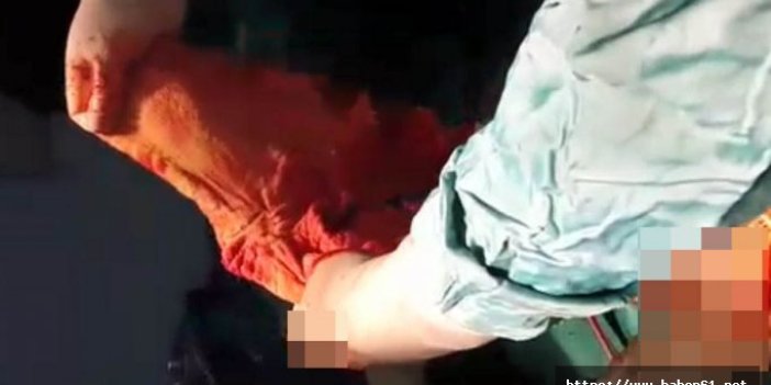 Şok olay! Trabzon'da kadının karnından havlu çıktı