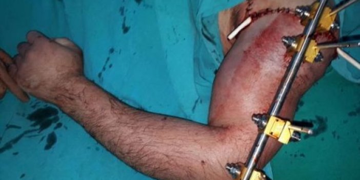 Suriyeli işçinin kolu Kayseri'de koptu, Adana'da yerine dikildi