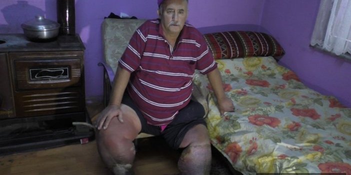  Fil hastası adam, sağlığına kavuşmanın hayalini kuruyor 