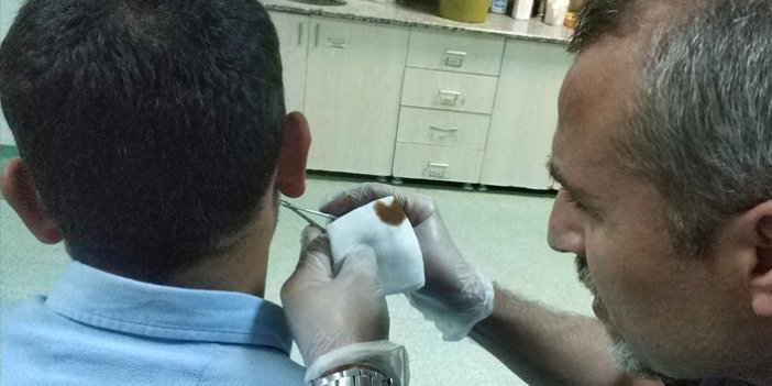 Samsun'da bir kişinin kulağının arkasına kene tutundu | Samsun Haberleri