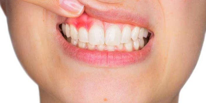 Yanlış diş fırçası kullanımı diş eti rahatsızlıklarına sebep oluyor