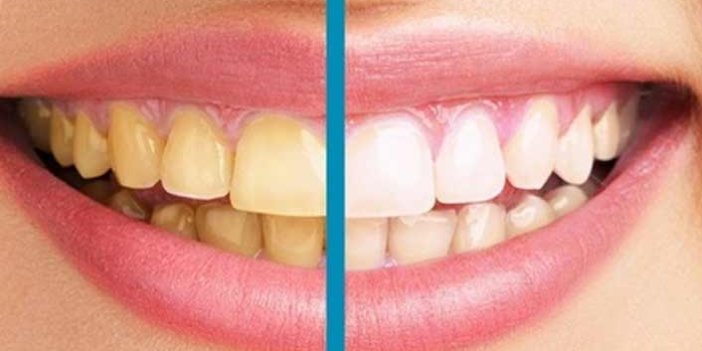 Dişlerdeki sararmalar gülüşü etkiliyor