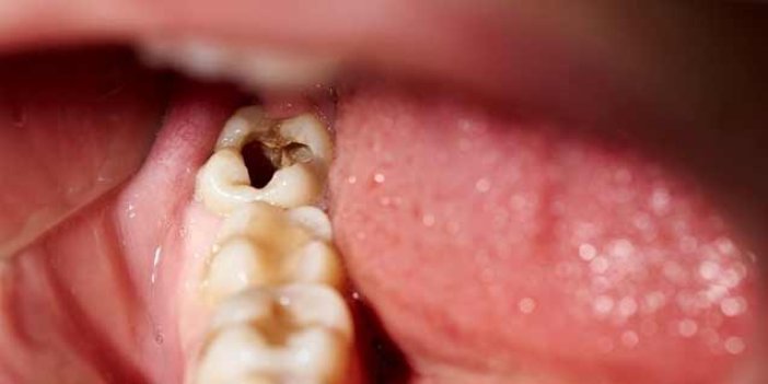 Diş çürükleri ölümcül olabiliyor