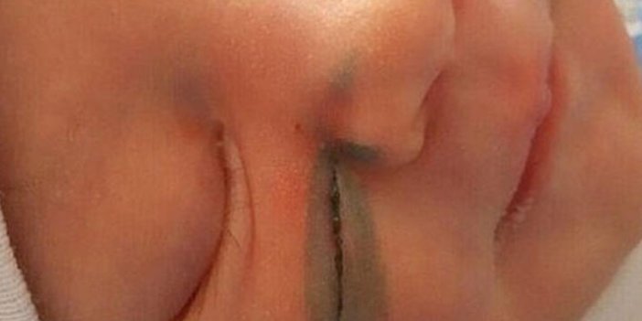 Doktorlar doğum sırasında bebeğin yüzünü kesti