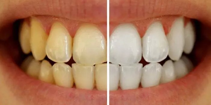 Dişlerde oluşan sararmalara dikkat!