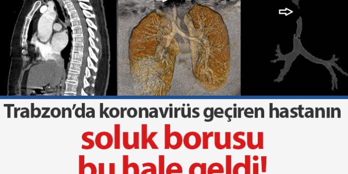 Trabzon'da koronavirüs geçiren hastanın soluk borusunda daralma oluştu
