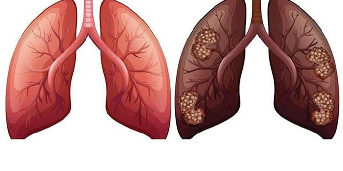 Akciğer kanserinde en büyük etken tütün