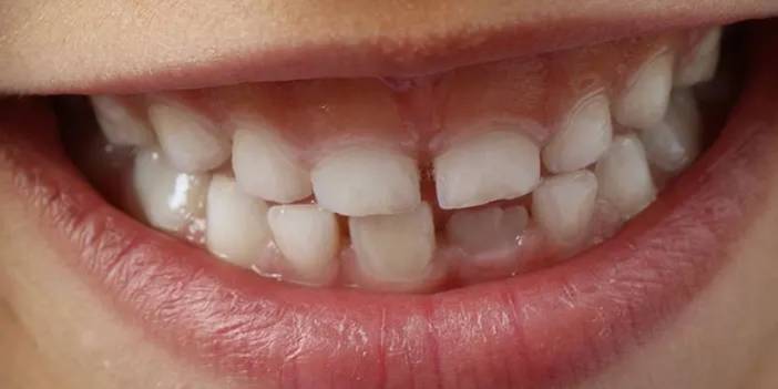 Dişlerinin görünümünden rahatsız olan hastalar tel takmadan da düzgün dişlere sahip olabilirler mi?