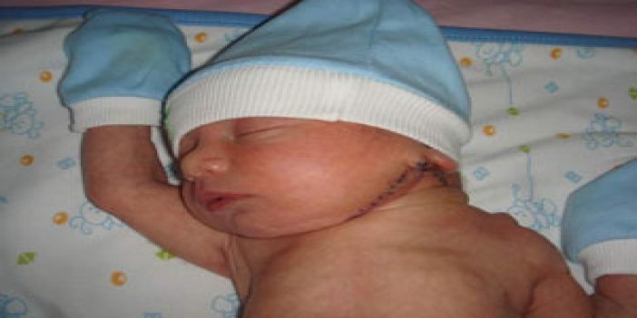 11 aylık bir bebeğe "biyonik'' kulak
