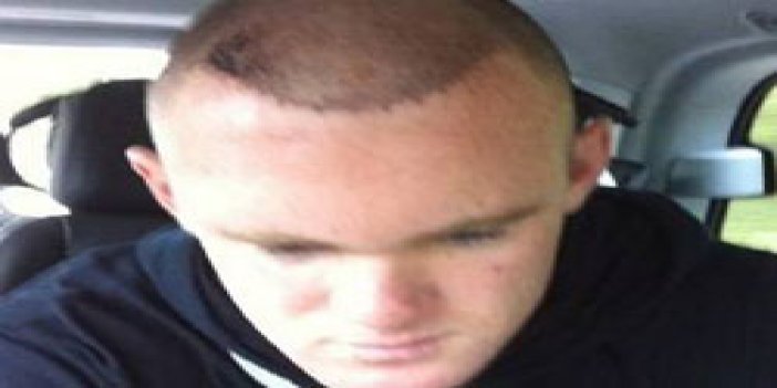 İşte Rooney'in saç ektirmiş hali
