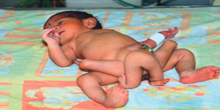 Altı bacaklı bebek dünyaya geldi