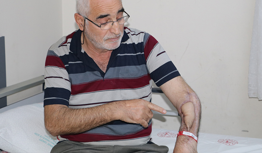 Çürüyen kolunu Trabzon'da doku nakli ile kurtarıldı